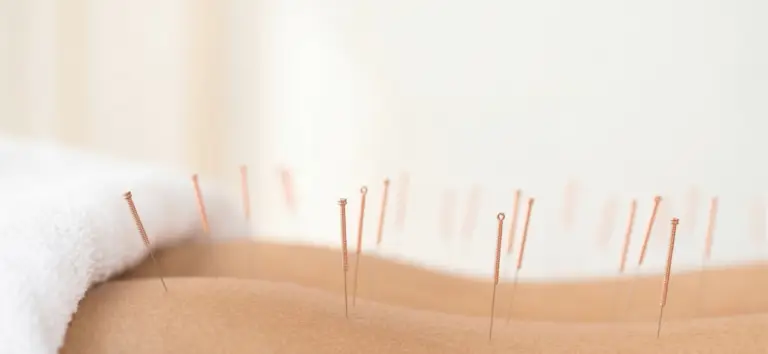 Akupunktur Schönbühl